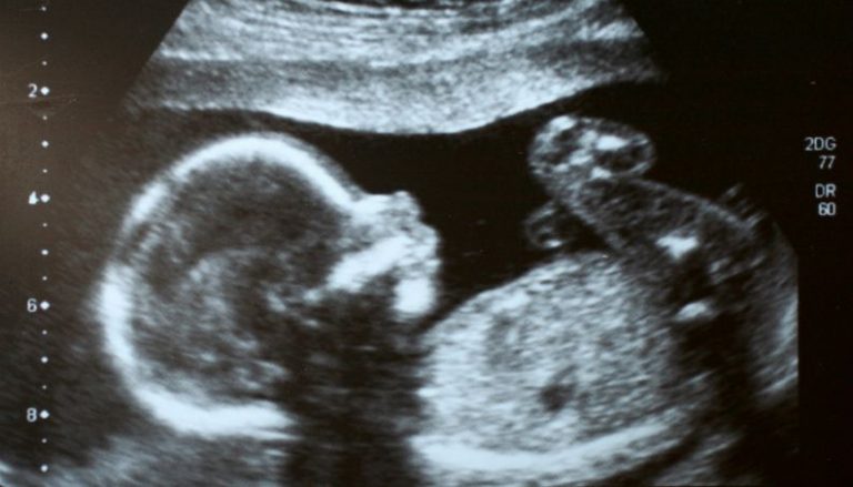 Sexagem fetal, 8 semanas