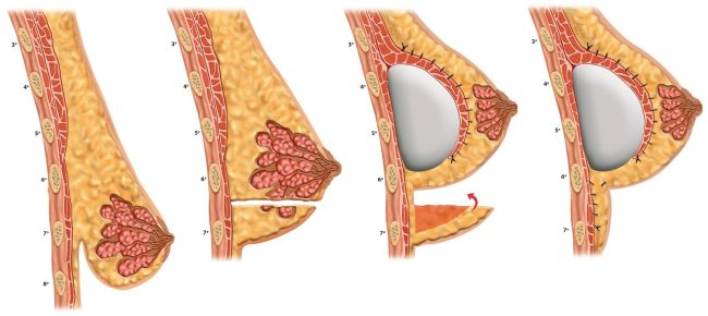 Técnica brasileira de mastopexia é sistematizada
