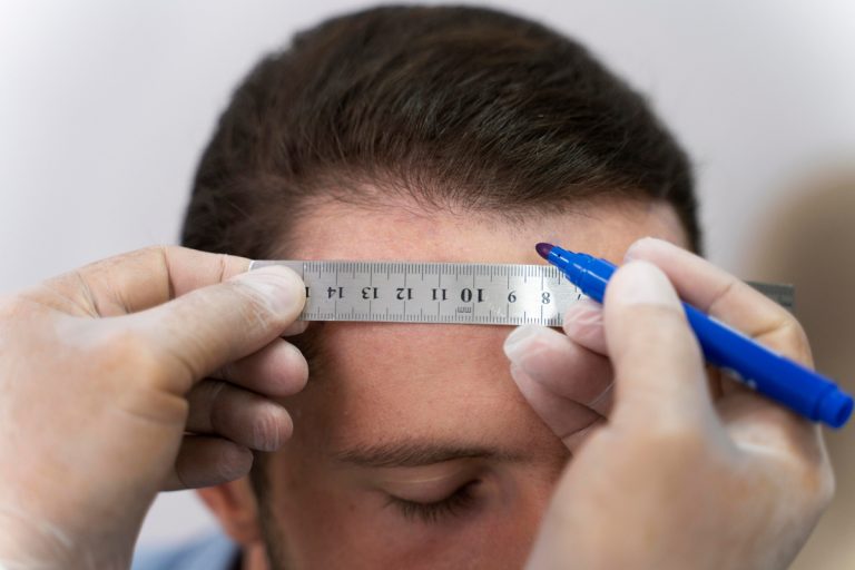 Queda capilar: médico explica quando considerar transplante