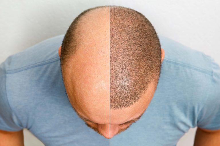 Personalização maximiza efeitos do transplante capilar